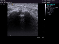 ultrasound probe