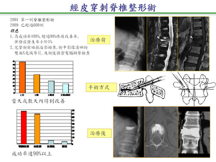 經皮椎體成形術微創手術影像