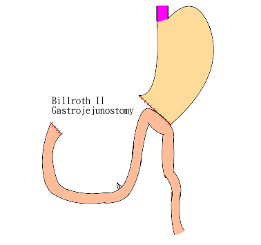 「subtotal gastrectomy with b-ii anastomosis」的圖片搜尋結果