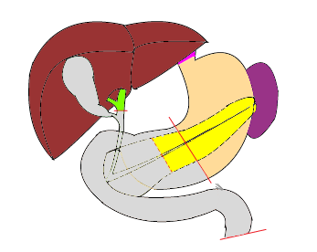pancreaticoduodenectomy