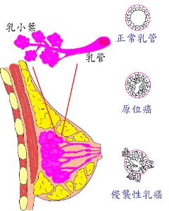 乳癌類型 嘉義長庚一般外科