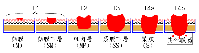 胃癌 嘉義長庚一般外科